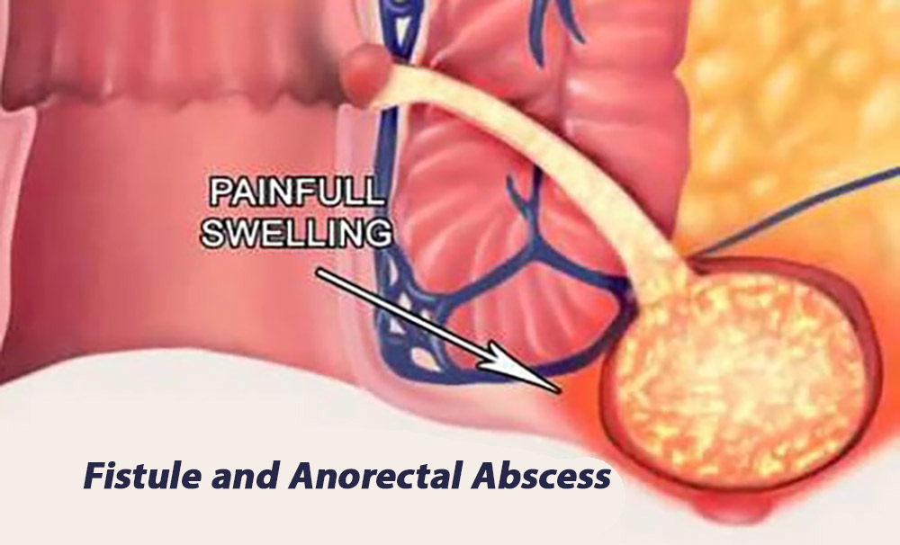 anorectal fistule and abscess
