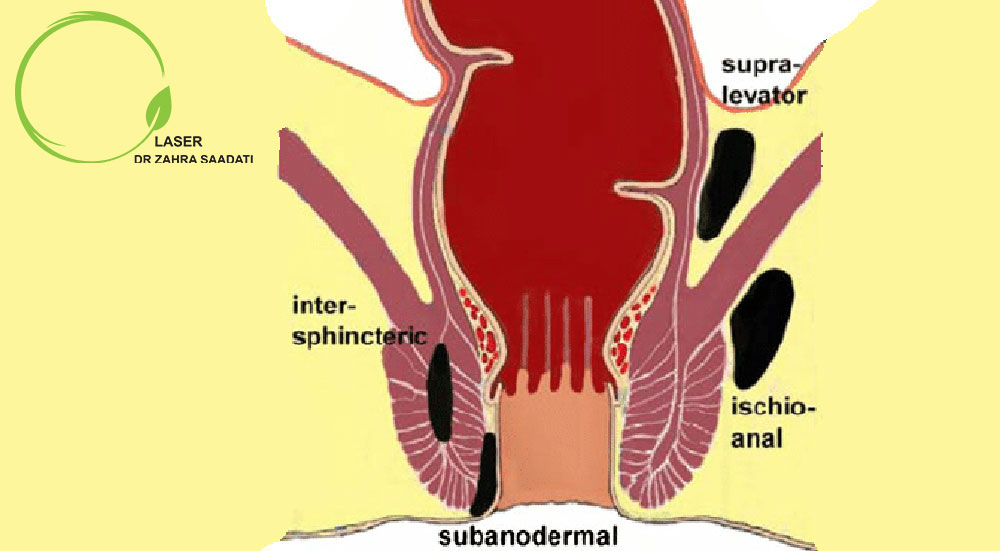 Schematic classification of types of superficial anal abscess, between muscles, above the anus and isioanal