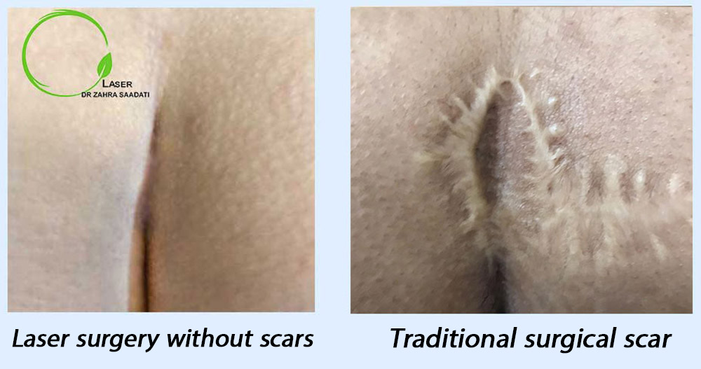 A photo of a pilonidal cyst that was operated on the left side with a laser and without a scar, and on the right side that was operated without a laser and with a scar.
