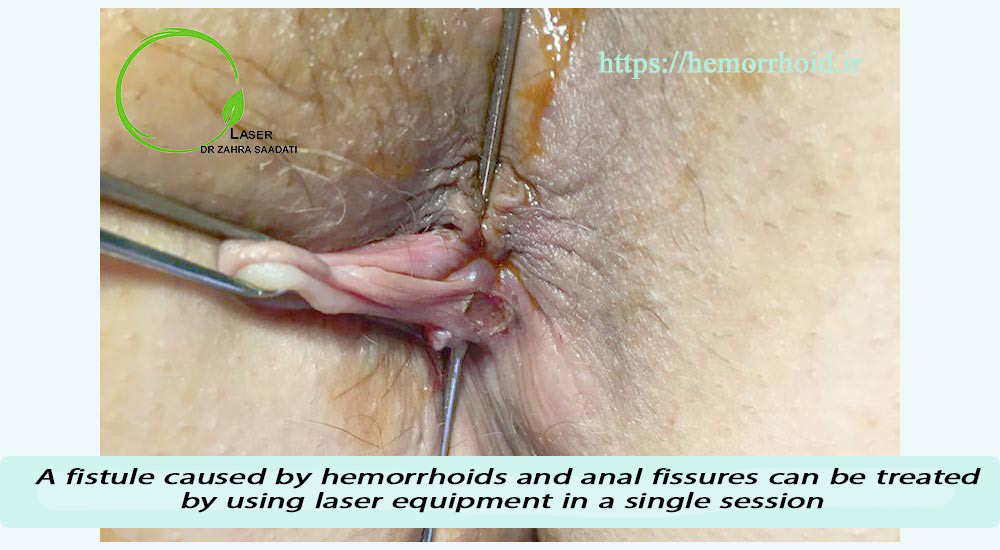 A fistula caused by hemorrhoids and anal fissures can be treated using laser equipment in a single session