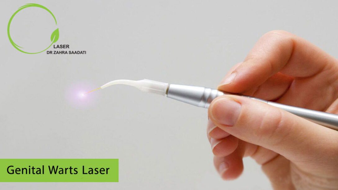 Genital warts laser Dr. Zahra Saadati Laser Surgery