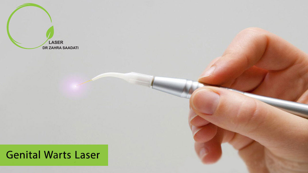Genital warts laser