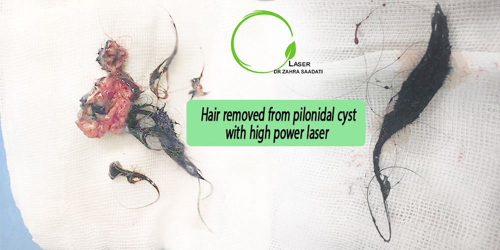A high-power laser can drain and remove all hair, hair roots, and damaged tissues