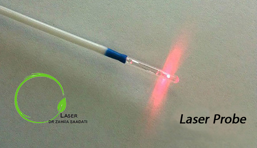 laser probe for anorectal fistule laser