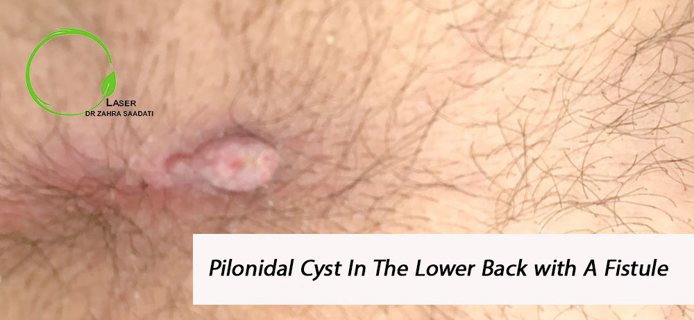 pilonidal cyst and fistule