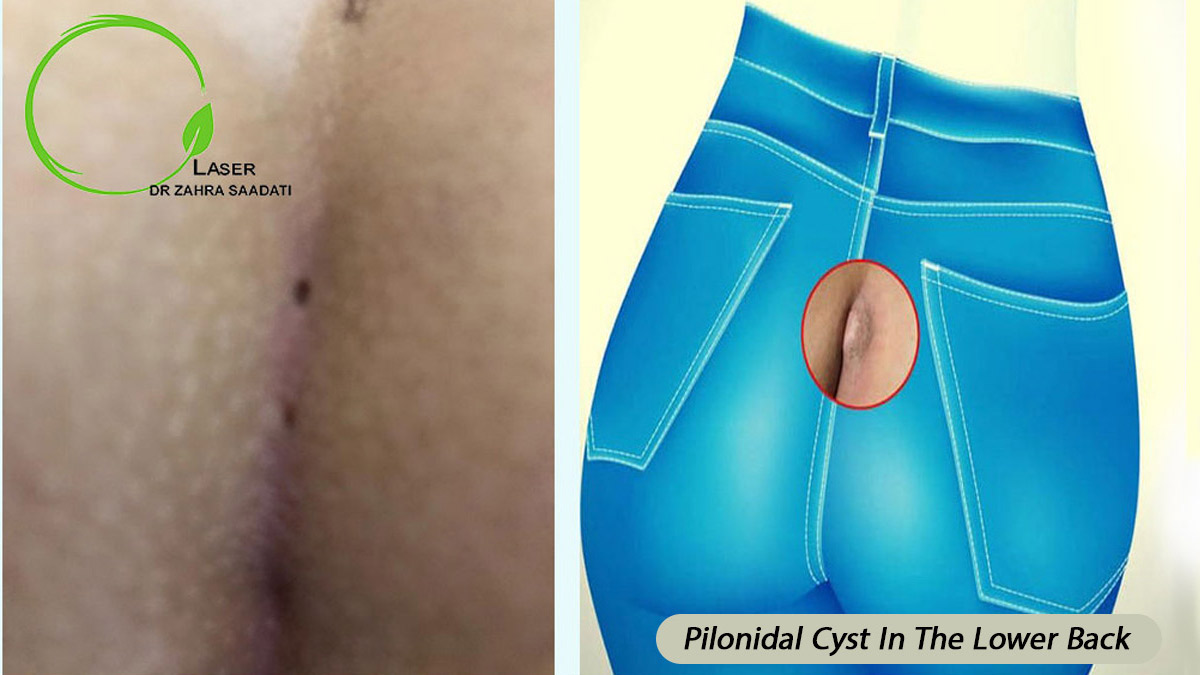 Pilonidal cyst in the lower back