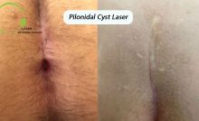 Images of hemorrhoids or piles - Dr. Zahra Saadati Laser Surgery