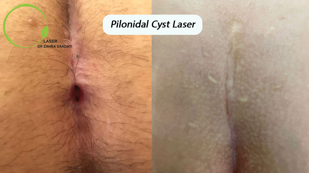 Pilonidal cyst laser before and after