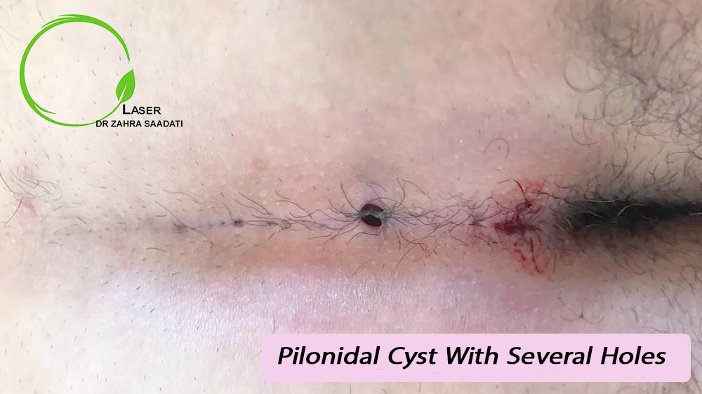 pilonidal cyst with several holes