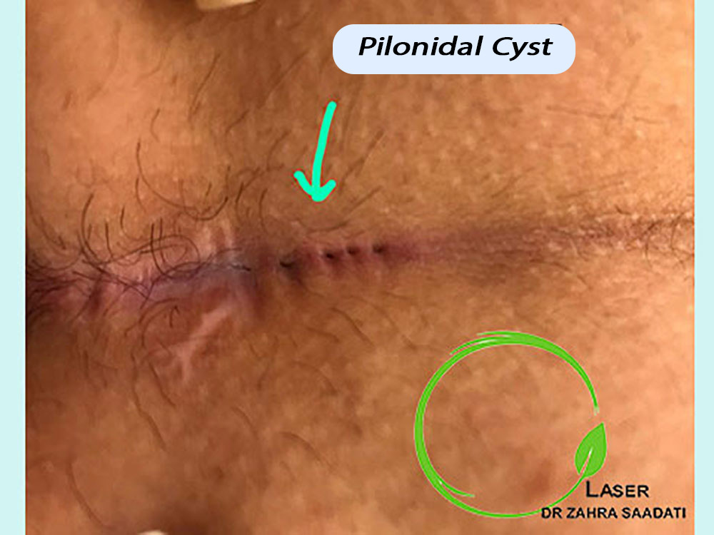 Diagnosis of lower back pilonidal cyst with several holes in the area