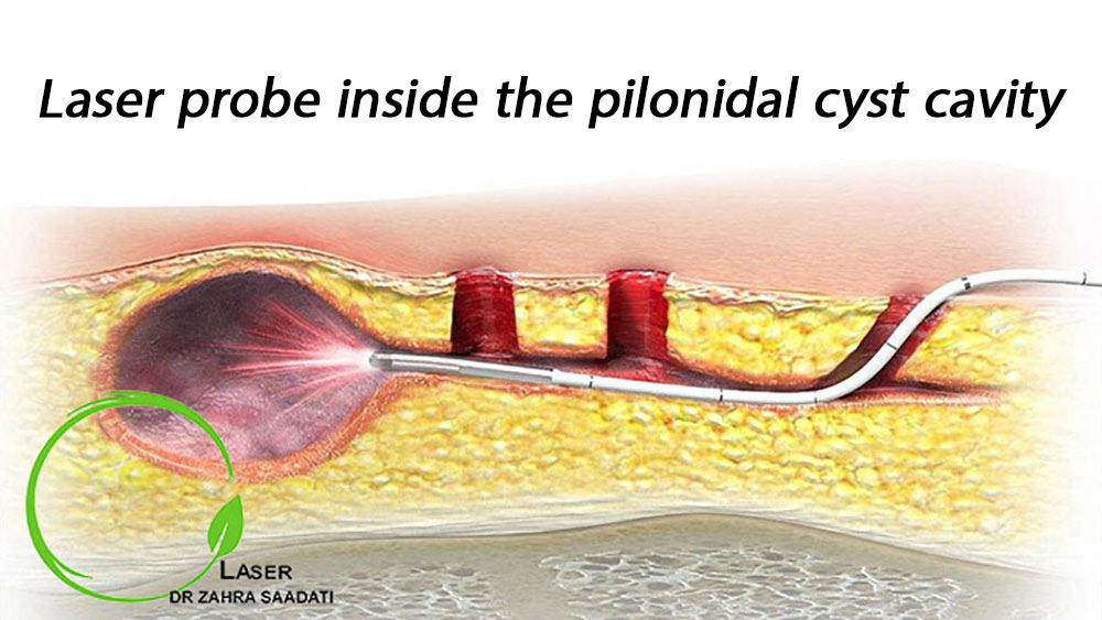 pilonidal cyst laser treatment with a laser probe inside the pilonidal cyst cavity