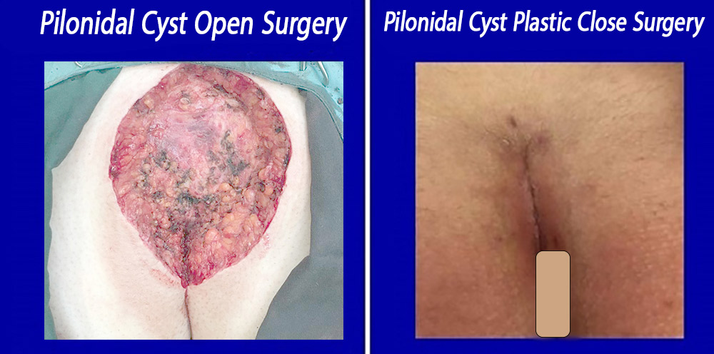 Comparison of closed pilonidal cyst laser and open surgery