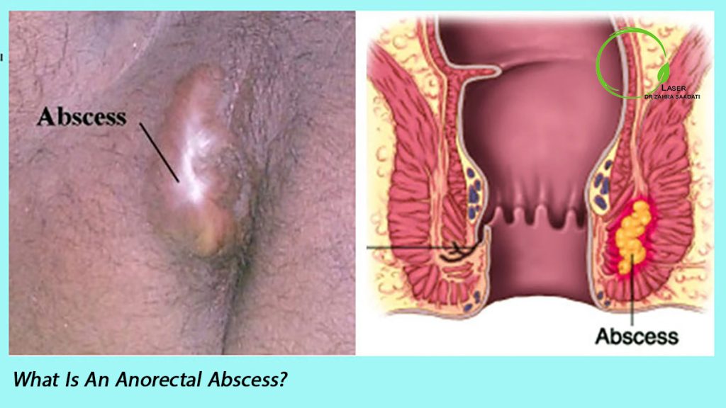 What is an anorectal abscess