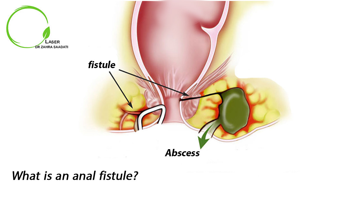 What is an anal fistule