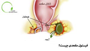 فیستول مقعدی چیست؟