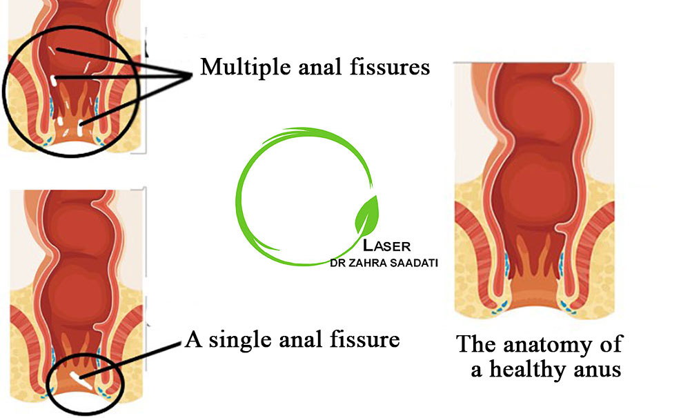 Anal fissure surgery Dr. Zahra Saadati Laser Surgery