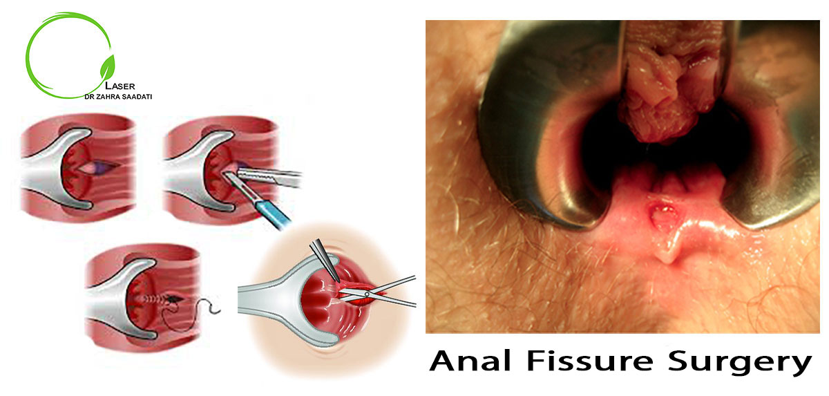 anal fissure surgery