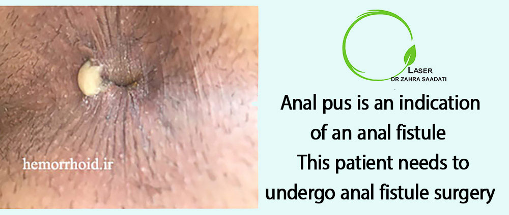 The discharge of pus from the anus is a sign of fistule and requires surgery