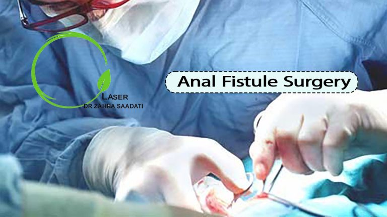 anal fistule surgery