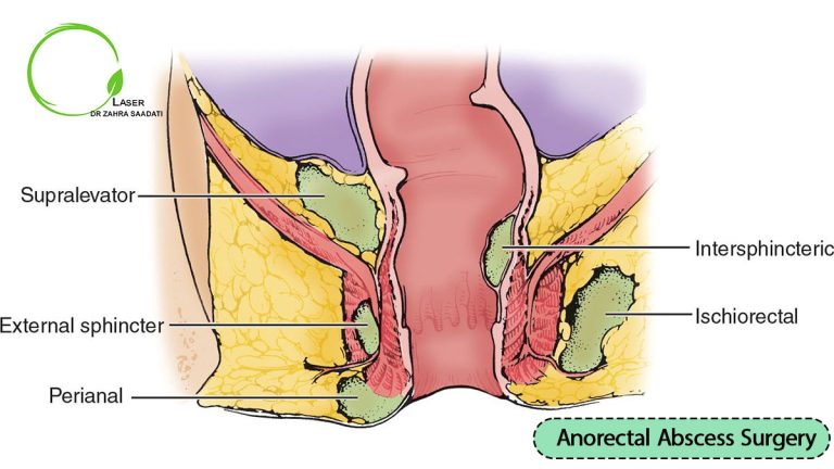 Anorectal abscess surgery