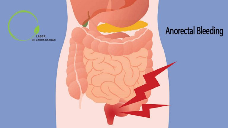 anorectal bleeding