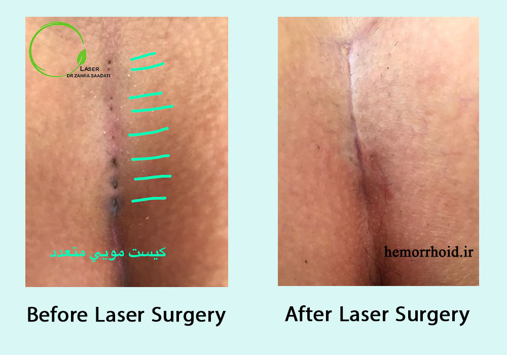 Before and after pilonidal sinus closed surgery with laser
