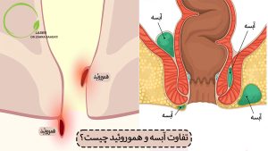 تفاوت آبسه مقعدی و هموروئید