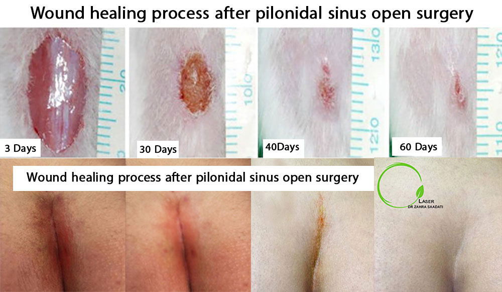 Wound healing process after pilonidal sinus open surgery and closed plastic surgery with laser