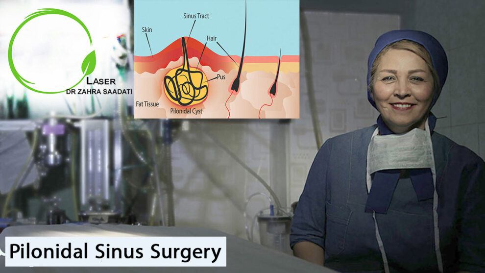 Pilonidal Sinus Surgery Dr. Zahra Saadati Laser Surgery