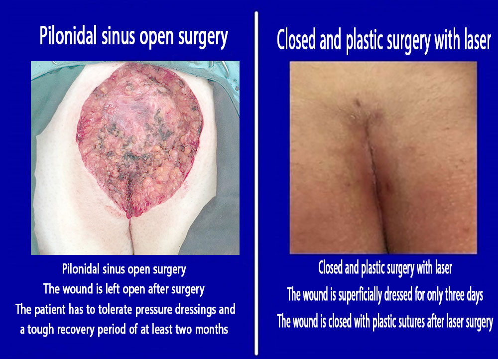 Comparison of open and closed pilonidal cyst surgery