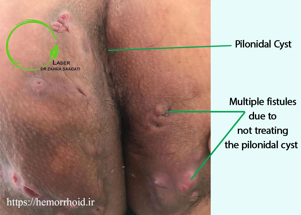 Untreated pilonidal sinus with multiple anal fistulas