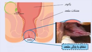 همه چیز درباره پارگی مقعد