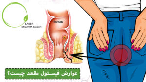 عوارض فیستول مقعد چیست