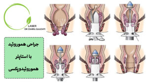 جراحی هموروئید با استاپلر یا جراحی هموروئیدوپکسی