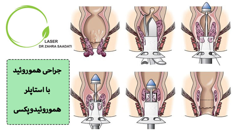 جراحی هموروئید با استاپلر یا جراحی هموروئیدوپکسی