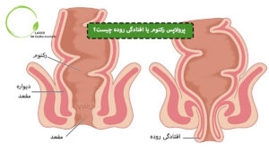 پرولاپس یا افتادگی روده چیست