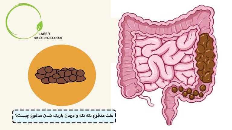 علت مدفوع تکه تکه و درمان باریک شدن مدفوع چیست