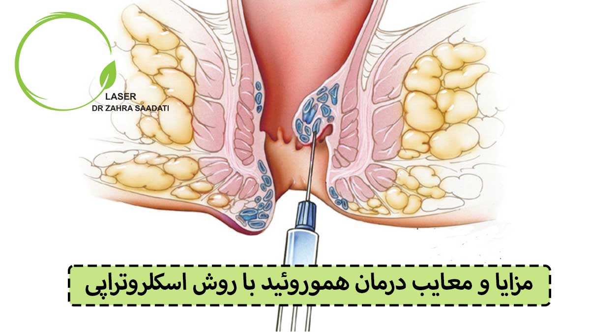 مزایا و معایب درمان هموروئید با روش اسکلروتراپی