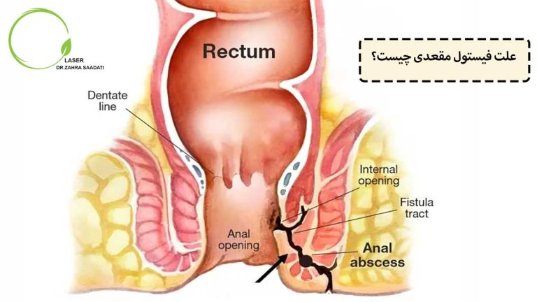 علت فیستول مقعدی