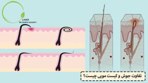 تفاوت جوش و کیست مویی چیست