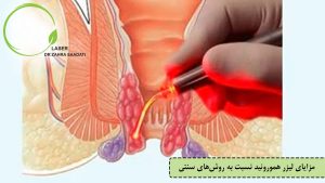 مزایای لیزر هموروئید نسبت به روش‌های سنتی