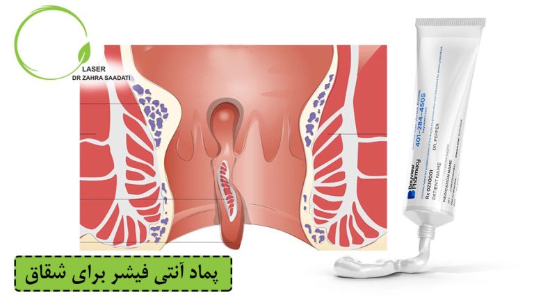 انواع پماد آنتی فیشر برای شقاق مقعدی