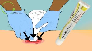 استفاده از لیدوکائین برای پانسمان زخم کیست مویی