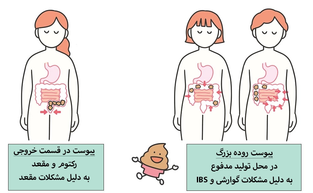 گیر کردن مدفوع در مقعد یا راست روده که به دلیل یبوست و مشکلات گوارشی بروز می کند.