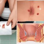 بیماری که با مشاهده سوراخ های فیستول و ترشحات مقعدی متوجه عود فیستول مقعدی شده است