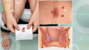 بیماری که با مشاهده سوراخ های فیستول و ترشحات مقعدی متوجه عود فیستول مقعدی شده است