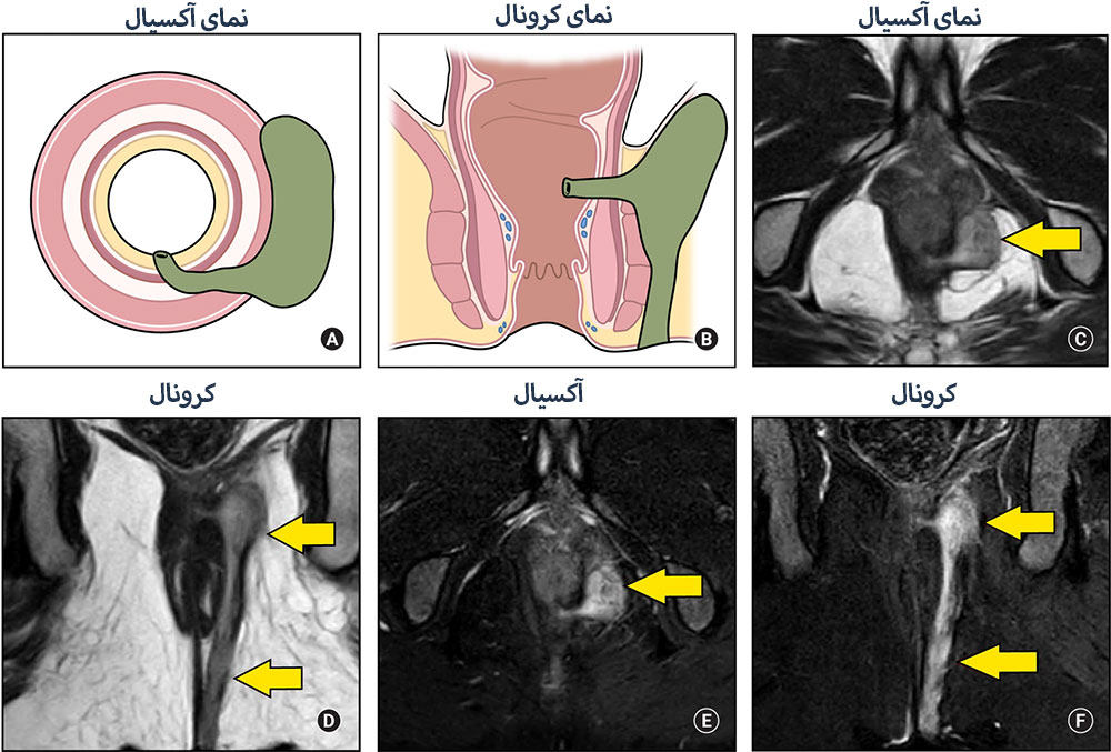 علائم و نشانه های فیستول مقعدی عود کرده در تصویربرداری
