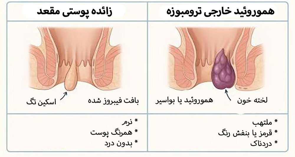 تفاوت ظاهری برای تشخیص بواسیر خارجی و اسکین تگ و زائده های پوستی مقعد
