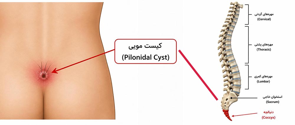 کیست مویی از علل درد دنبالچه در انتهای ستون فقرات